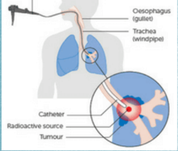 Điều trị ung thư bằng cấy hạt phóng xạ